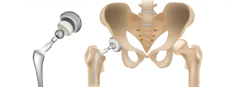 Hip Replacement anatomy illustration