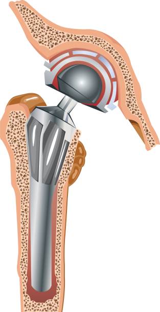 Partial Hip Replacement anatomy illustration
