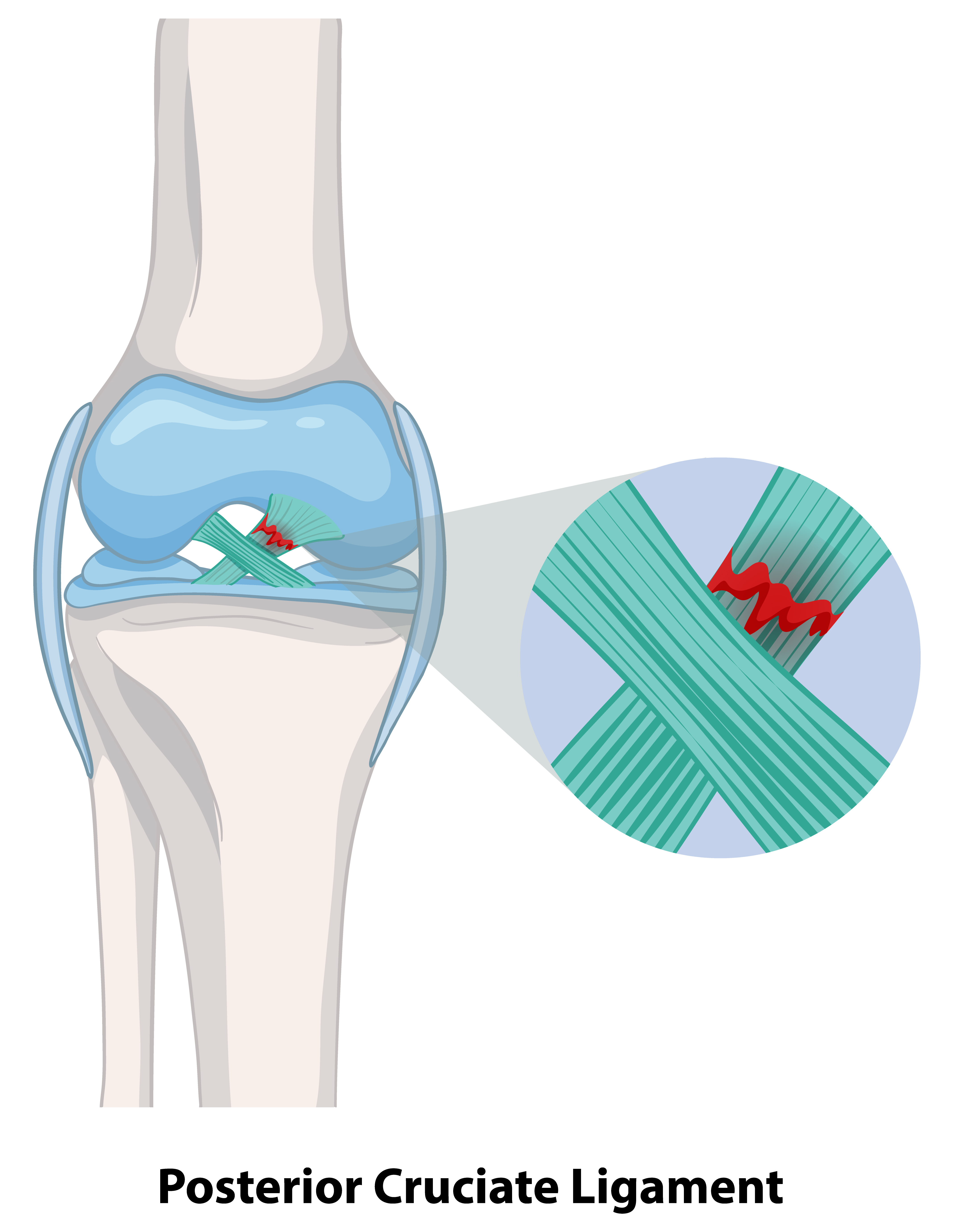 Partial Knee Replacement anatomy illustration