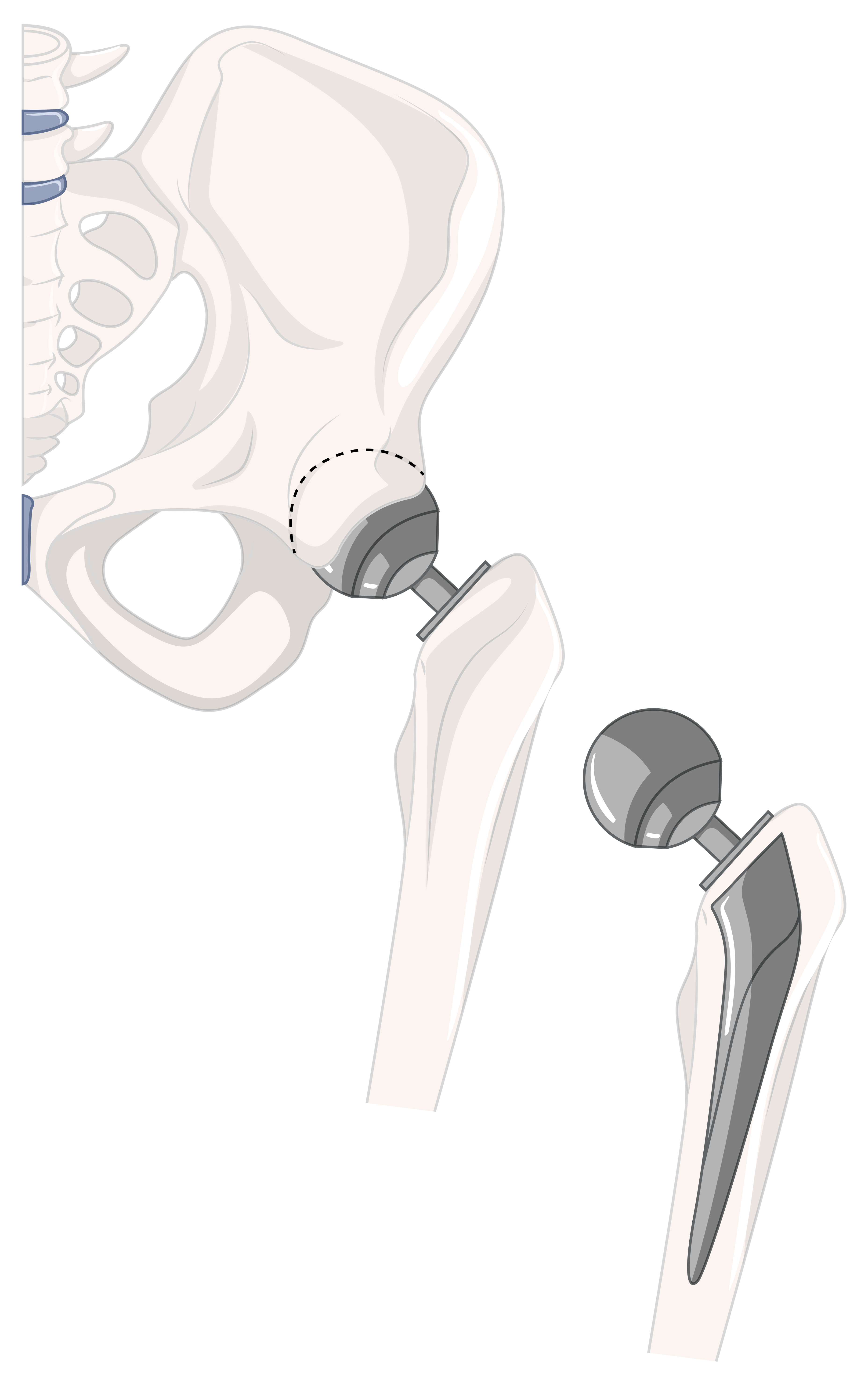 Revision Hip Replacement anatomy illustration