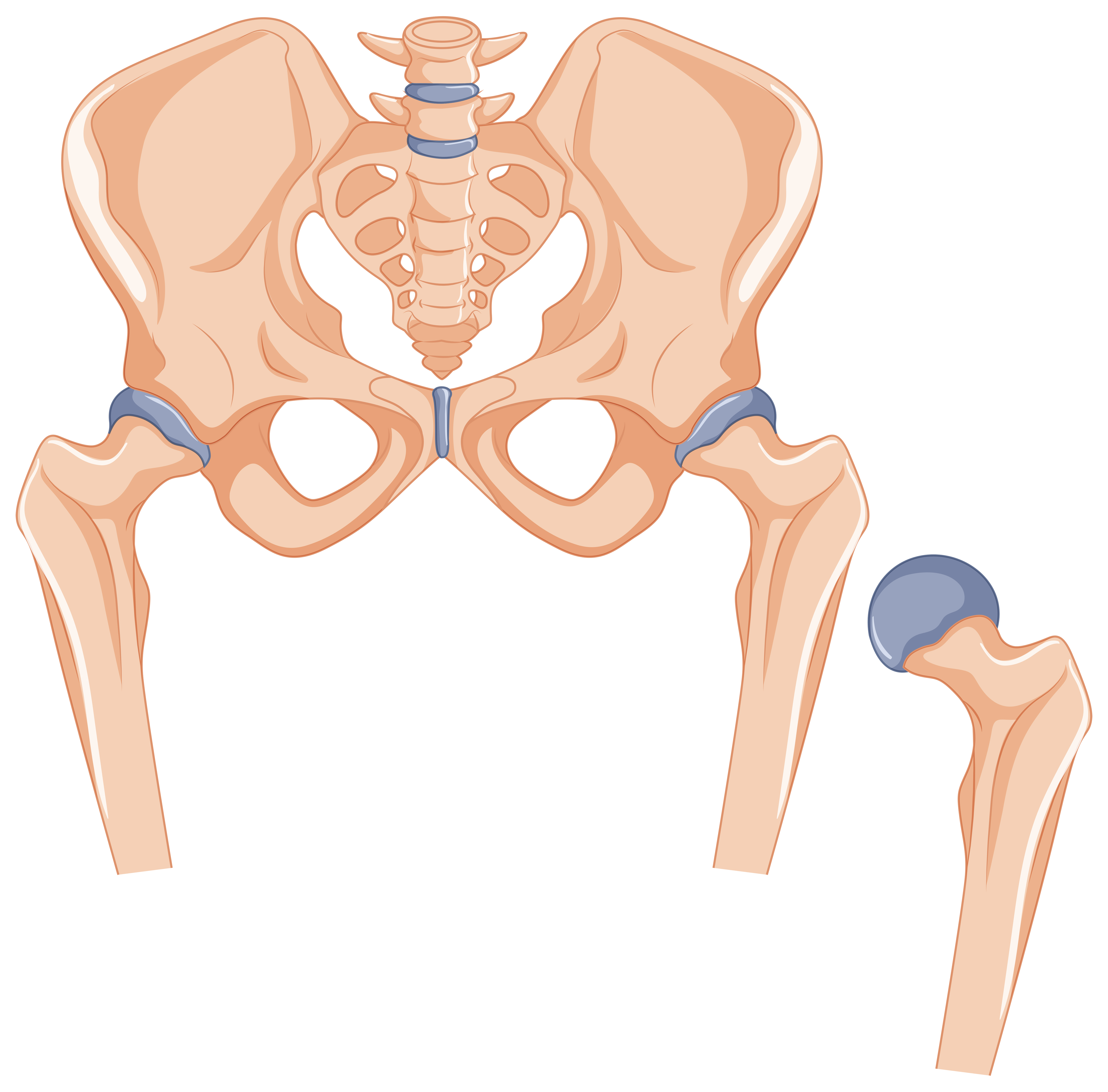 Total Hip Replacement anatomy illustration