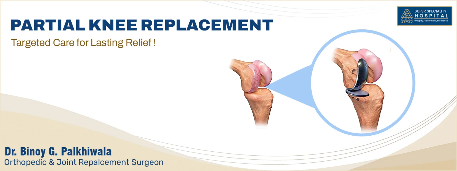 Partial Knee Replacement
